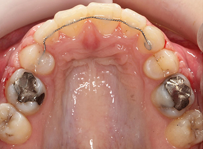 After - Bright Orthodontics