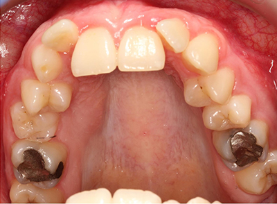 Before - Bright Oorthodontics