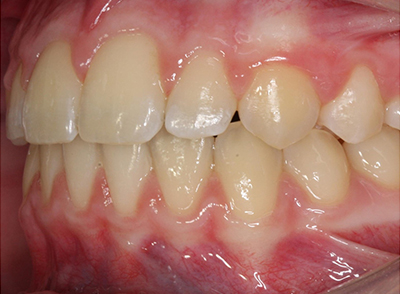 After - Bright Orthodontics