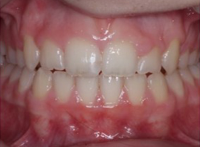 After - Bright Orthodontics
