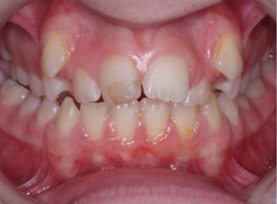 Before - Bright Oorthodontics