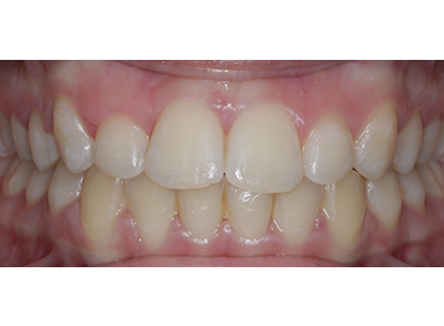 After - Bright Orthodontics