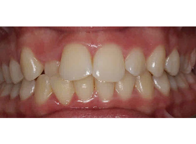 Before - Bright Oorthodontics