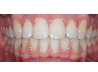 After - Bright Orthodontics