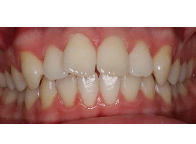 Before - Bright Oorthodontics