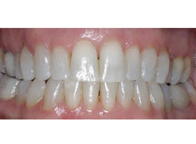 After - Bright Orthodontics