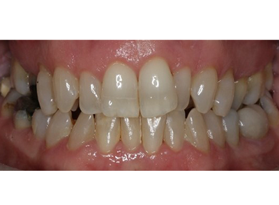 Before - Bright Oorthodontics