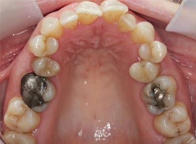 Before - Bright Oorthodontics