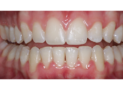 After - Bright Orthodontics