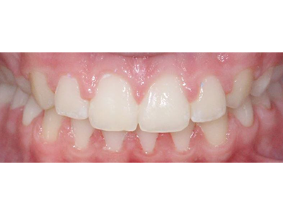 After - Bright Orthodontics