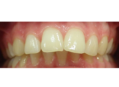 Before - Bright Oorthodontics