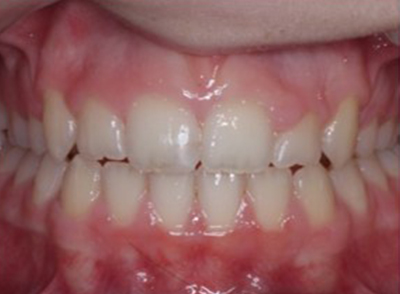 After - Bright Orthodontics