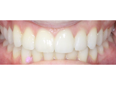 After - Bright Orthodontics