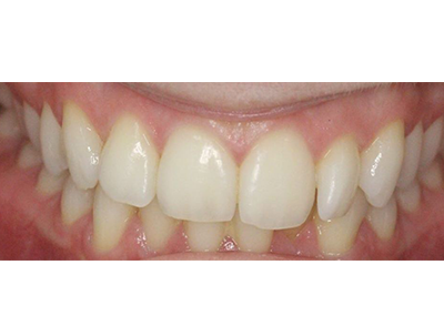 Before - Bright Oorthodontics