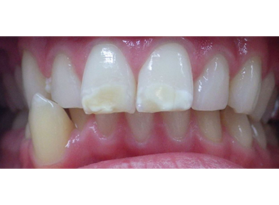 Before - Bright Oorthodontics