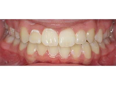 After - Bright Orthodontics