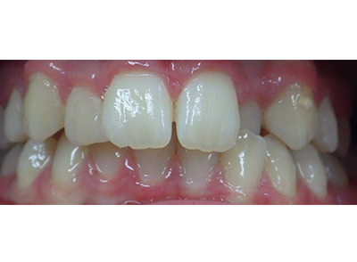 Before - Bright Oorthodontics