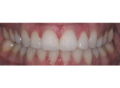 After - Bright Orthodontics