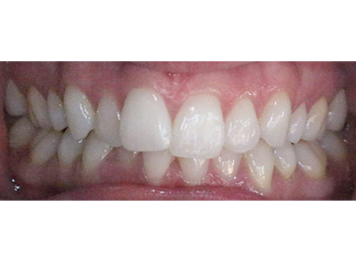 Before - Bright Oorthodontics