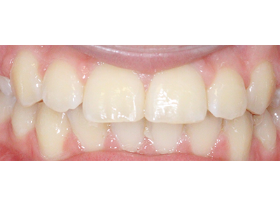 After - Bright Orthodontics