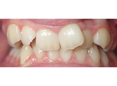 Before - Bright Oorthodontics