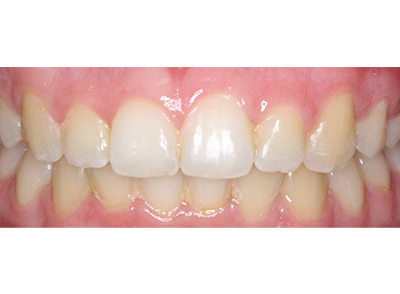 After - Bright Orthodontics