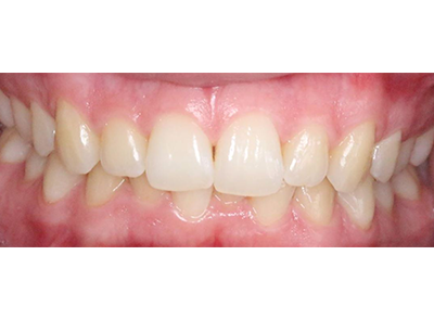 Before - Bright Oorthodontics