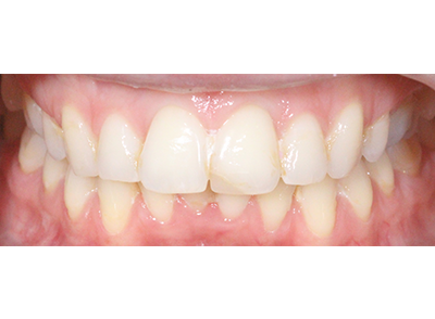 After - Bright Orthodontics