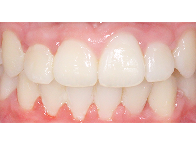 After - Bright Orthodontics