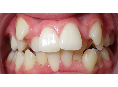 Before - Bright Oorthodontics