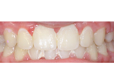 After - Bright Orthodontics