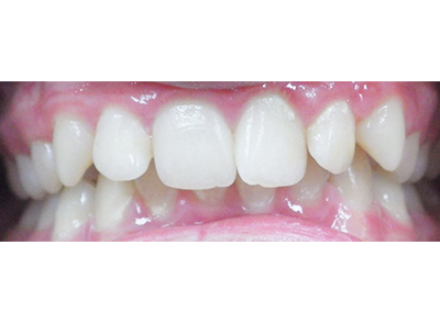 Before - Bright Oorthodontics