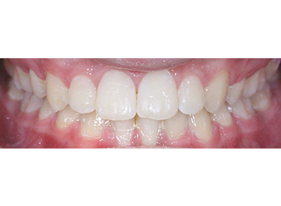 After - Bright Orthodontics