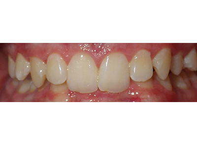 Before - Bright Oorthodontics