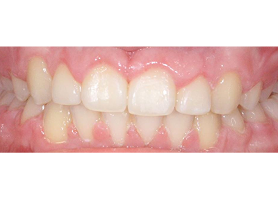 After - Bright Orthodontics