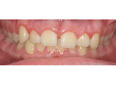 Before - Bright Oorthodontics