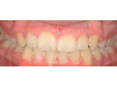 After - Bright Orthodontics