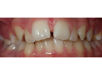 Before - Bright Oorthodontics