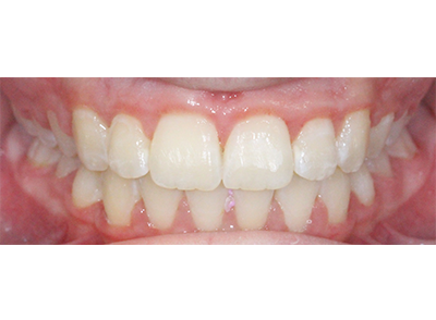 After - Bright Orthodontics