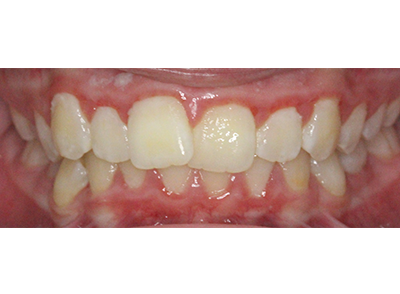 Before - Bright Oorthodontics