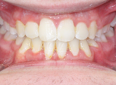 After - Bright Orthodontics