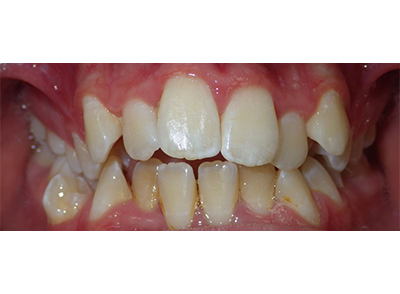 Before - Bright Oorthodontics