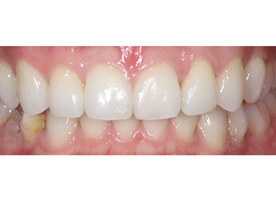 After - Bright Orthodontics