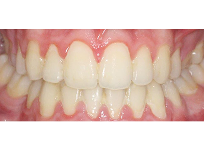 After - Bright Orthodontics