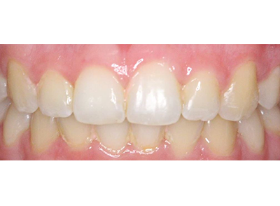 After - Bright Orthodontics