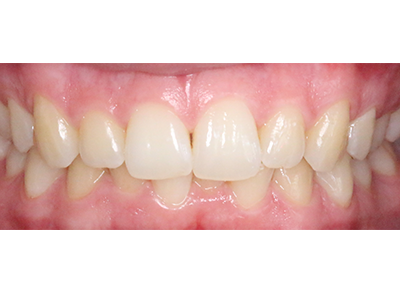 Before - Bright Oorthodontics