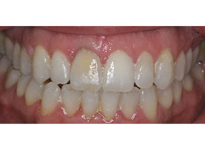 After - Bright Orthodontics