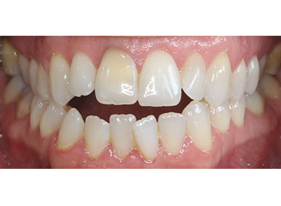 Before - Bright Oorthodontics