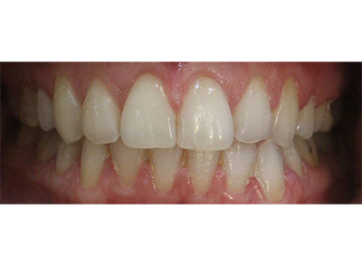 After - Bright Orthodontics