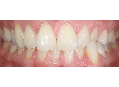 Before - Bright Oorthodontics